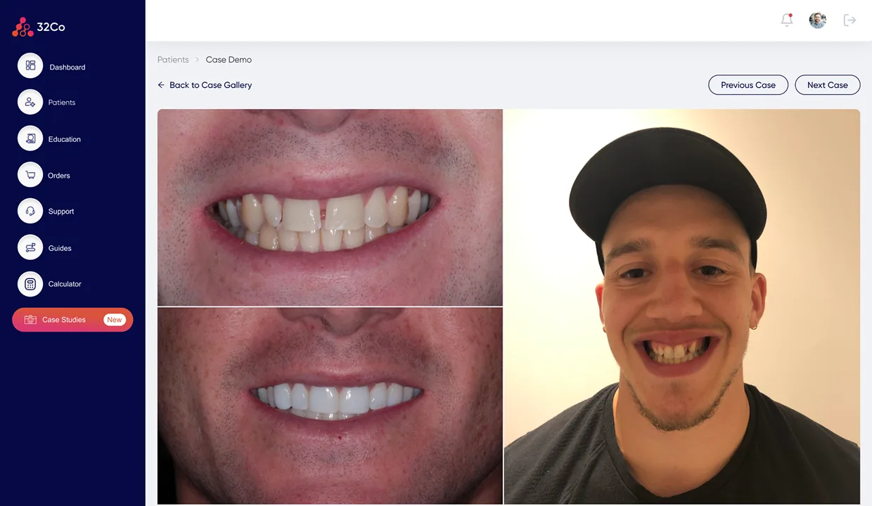 32co Case Studies · alternate detail view, case-study card expanded with full clinical context, treatment timeline, and supporting images; the same shell as the gallery, with the detail page reachable via URL so dentists can paste the case-study link straight into a patient conversation